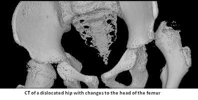 CT of a dislocated hip with changes to the head of the femur