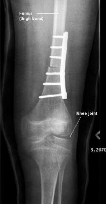 X-ray of knee joint with plate and screws on femur