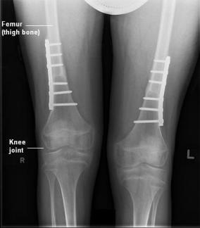 X-ray of thigh bone and knee joint with plate and screws on both femurs