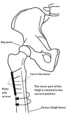 Diagram of hip joint showing cut in the bone, plate and screws, and the lower part of the thigh rotated to the correct position