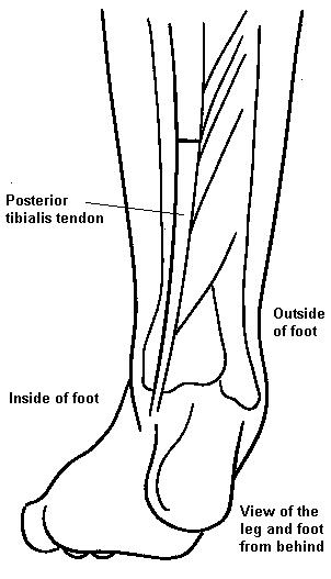 Diagram showing bones and tendons in the back of the lower leg, with a cut in the posterior tibialis tendon. Click for larger version.