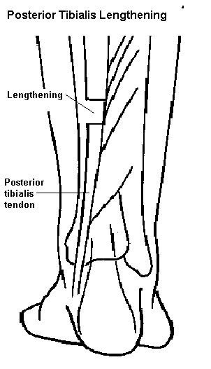 Diagram of bones and tendons in the back of the lower leg, with a gap cut into the posterior tibialis tendon. Click for larger version.