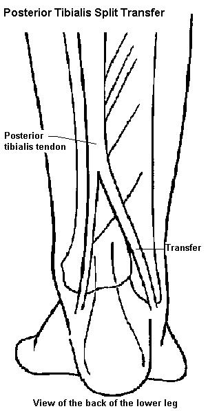 Diagram showing bones and tendons in the back of the lower leg. Click for larger version.