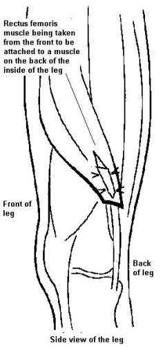Diagram of leg bones from the side, showing rectus femoris muscle being taken from the front to be attached to a muscle on the back of the inside of the leg