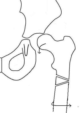 Diagram of subluxed hemi hip after varus derotation osteotomy