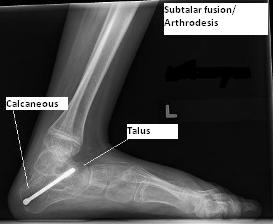 X-ray of foot after subtalar fusion surgery
