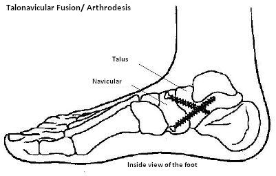Diagram showing inside view of bones of foot with screws after subtalar fusion. Click for larger version.