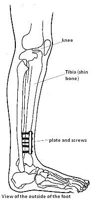 Diagram showing side view of the bones of the lower leg, with a plate and screws attached to the tibia (shin bone)