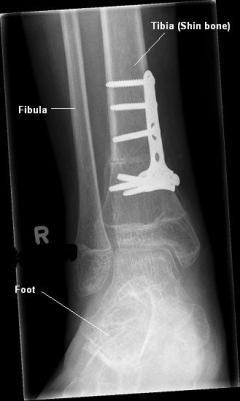 X-ray of plate and screws attached to tibia (shin bone)