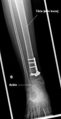 X-ray of plate and screws attached to tibia (shin bone)