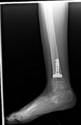 X-ray side view of plate and screws attached to tibia (shin bone)