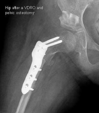 X-ray of hip after a VDRO and pelvic osteotomy, with plate and screws on leg bone. Click for larger version.