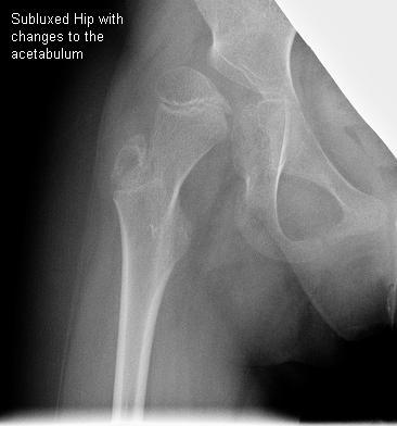 X-ray of subluxed hip with changes to the catebalum. Click for larger version.