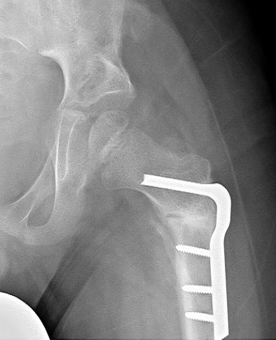 x-ray of corrected subluxed hip after surgery