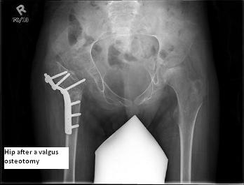 X-ray of hip after a valgus osteotomy. Click for larger version.