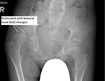 X-ray of dislocated hip with fermoral head (ball) changes. Click for larger version.