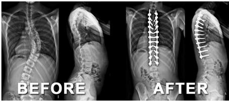 X-ray showing spine before and after scoliosis surgery