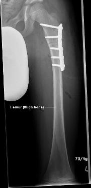 X-ray of hip joint with plate and screws attached to femur
