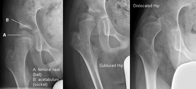 X-ray of an acetabulum and femoral head, X-ray of a subluxed (displaced) hip, X-ray of a dislocated hip