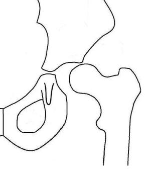 Drawing of a displaced hip
