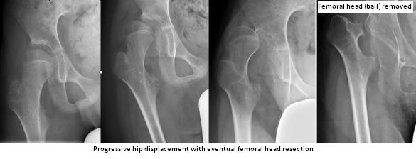 X-rays showing progressive hip displacement with eventual femoral head resection