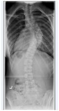 X-ray showing S-shaped spine