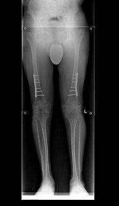 X-ray of legs with plate and screws on both femurs
