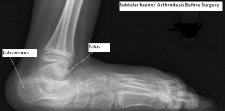 X-ray of foot before subtalar fusion surgery