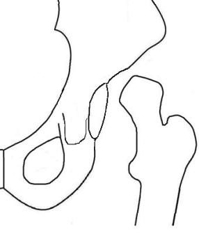 Drawing of a dislocated hip