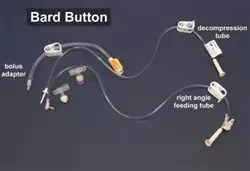 Photo of a Bard Button tube (mushroom-type device)