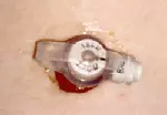 Photo of a feeding tube with hypergranulation tissue around it