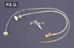 Photo of a PEG feeding tube