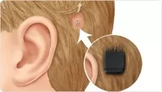 boneanchored hearing aids