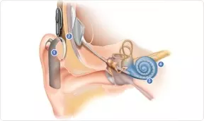 cochlear implant diagram