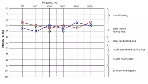 Image of an audiogram