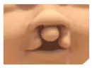 A rendering of a bilateral cleft