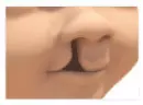 A rendering of a complete unilateral cleft
