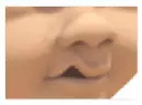 A rendering of a incomplete lateral cleft