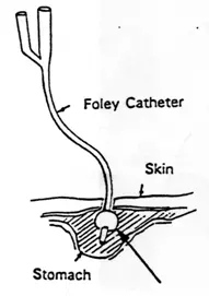 Diagram of Foley catheter